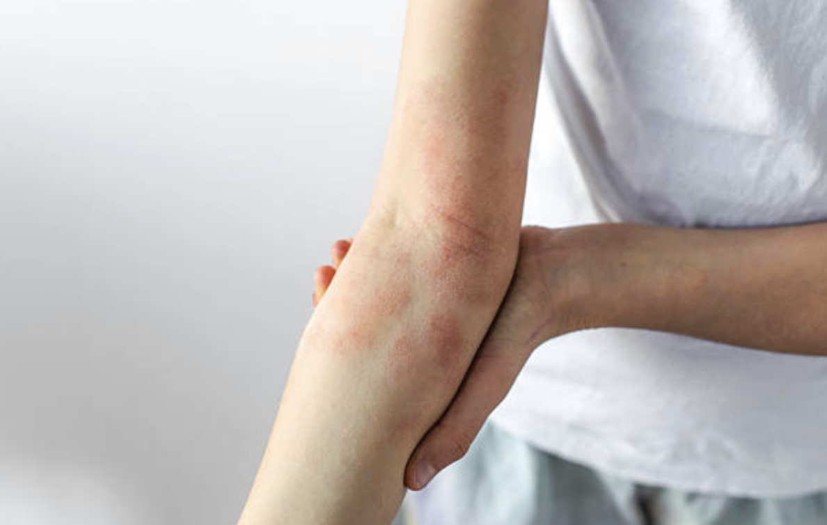 湿疹が繰り返すのはなぜ？原因になりやすい刺激と皮膚科での治療を解説