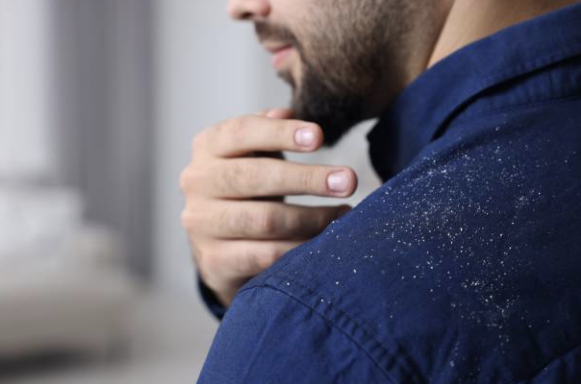 脂漏性皮膚炎 頭皮のかゆみ・フケの原因と治療法｜世田谷区駒沢の皮膚科