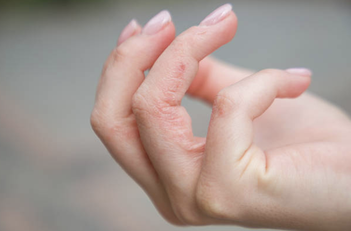 トゲが皮膚の中で取れない！原因と正しい対処法を皮膚科医が解説